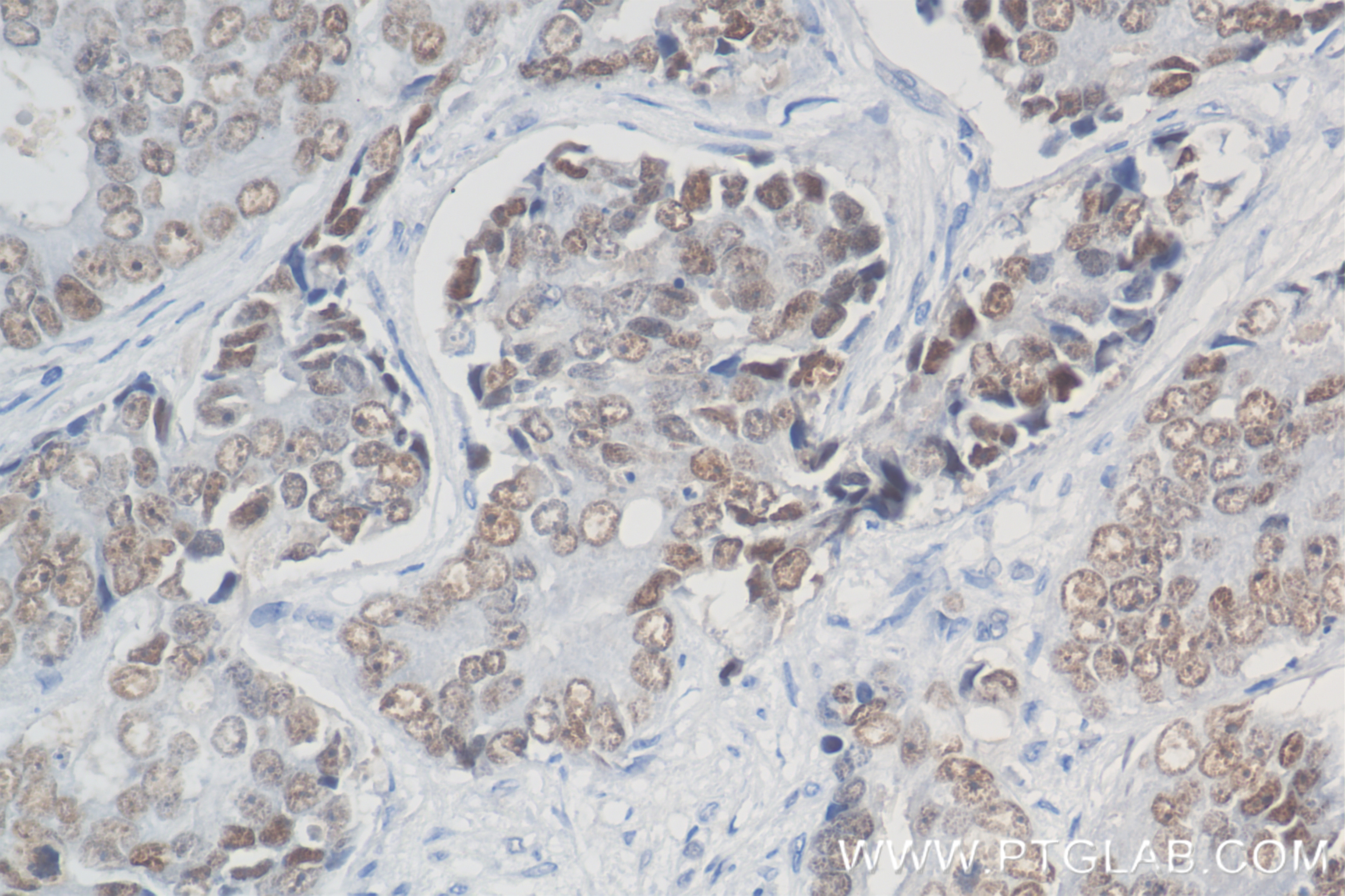 Immunohistochemistry (IHC) staining of human prostate cancer tissue using AR Recombinant antibody (81841-1-RR)