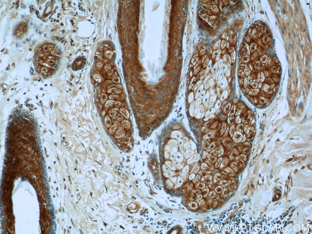 Immunohistochemistry (IHC) staining of human skin cancer tissue using ARAF Polyclonal antibody (22129-1-AP)