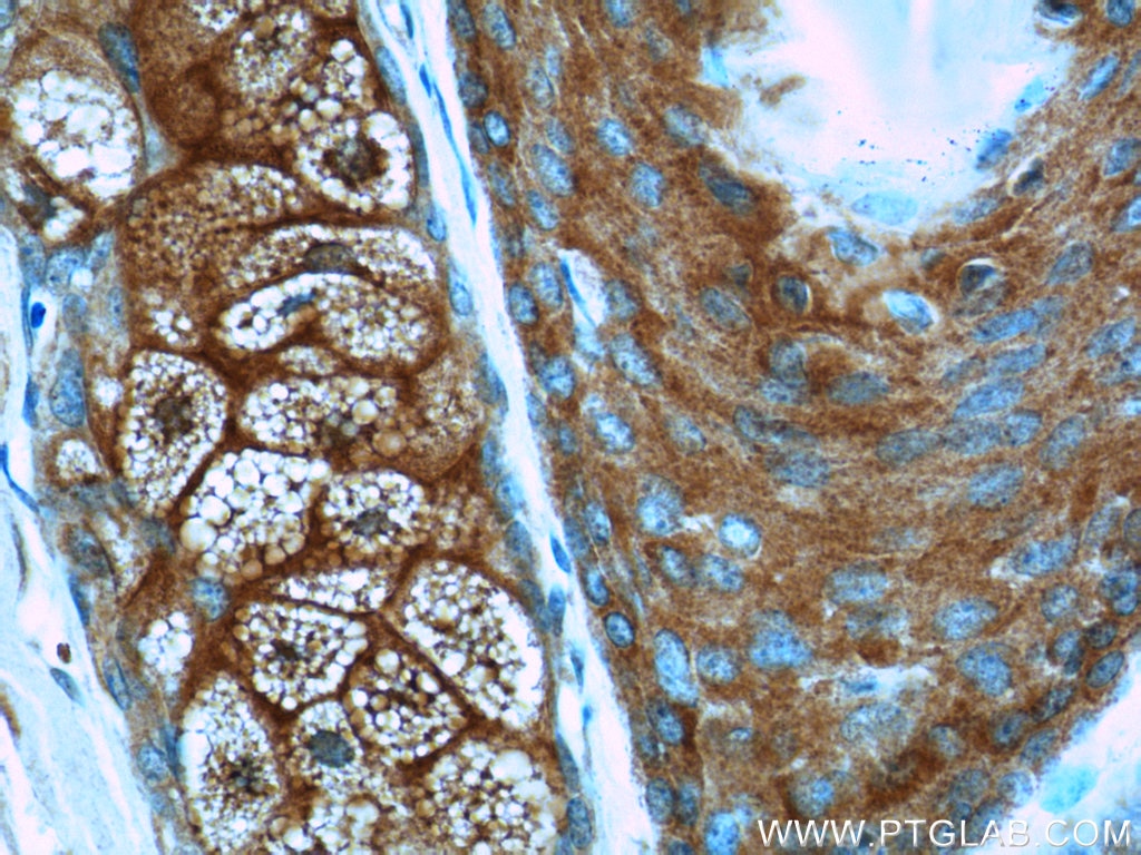 Immunohistochemistry (IHC) staining of human skin cancer tissue using ARAF Polyclonal antibody (22129-1-AP)
