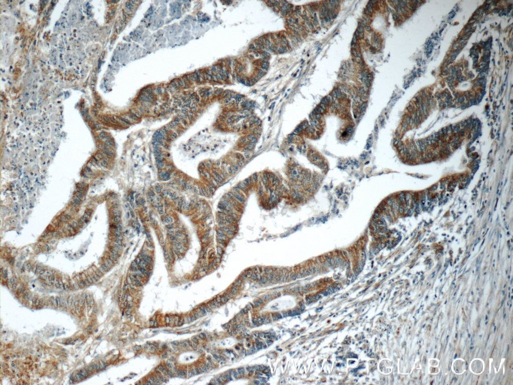 Immunohistochemistry (IHC) staining of human colon cancer tissue using ARAP3 Polyclonal antibody (22578-1-AP)