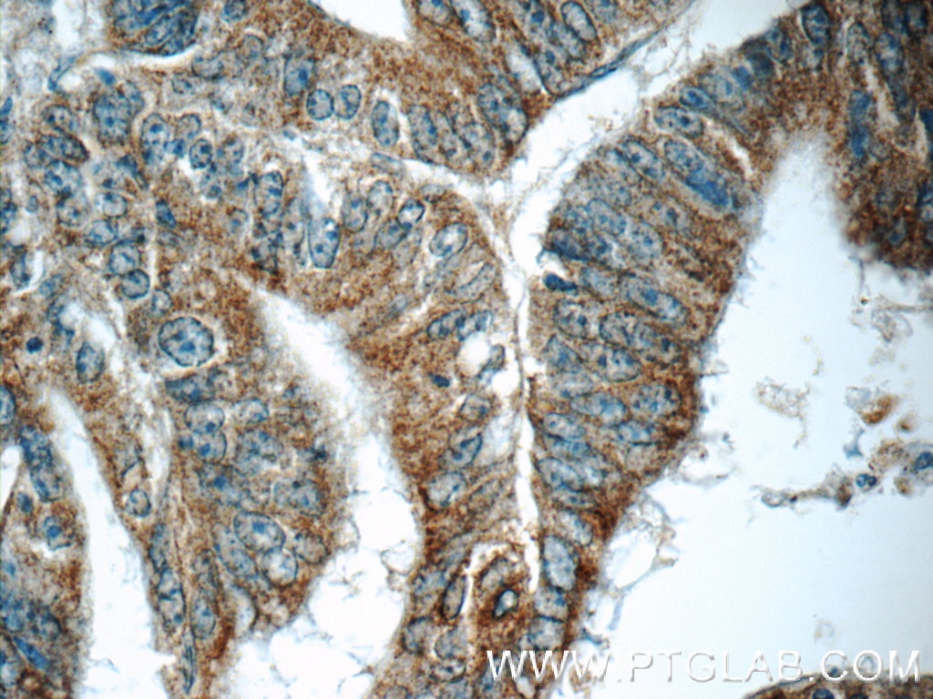 Immunohistochemistry (IHC) staining of human colon cancer tissue using ARAP3 Polyclonal antibody (22578-1-AP)