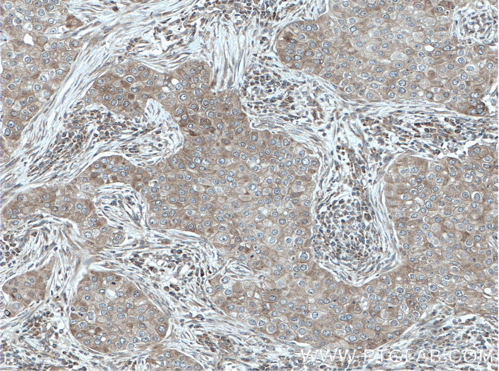 Immunohistochemistry (IHC) staining of human breast cancer tissue using ARD1A Polyclonal antibody (14803-1-AP)