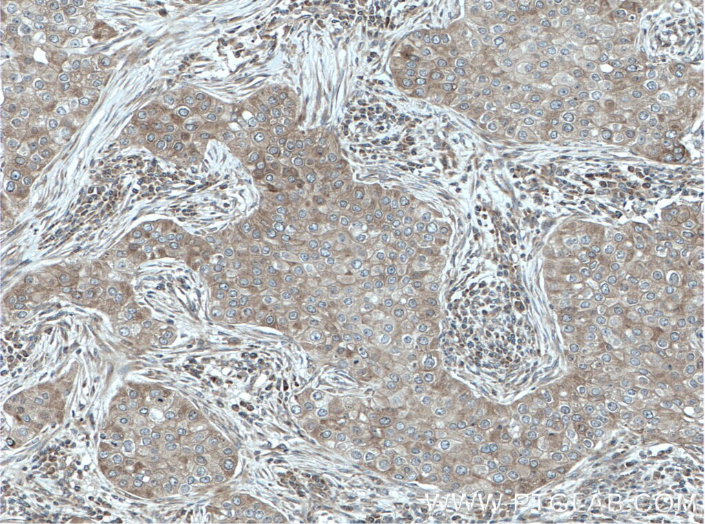 IHC staining of human breast cancer using 14803-1-AP