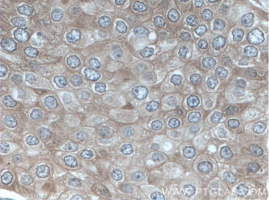 Immunohistochemistry (IHC) staining of human breast cancer tissue using ARD1A Polyclonal antibody (14803-1-AP)