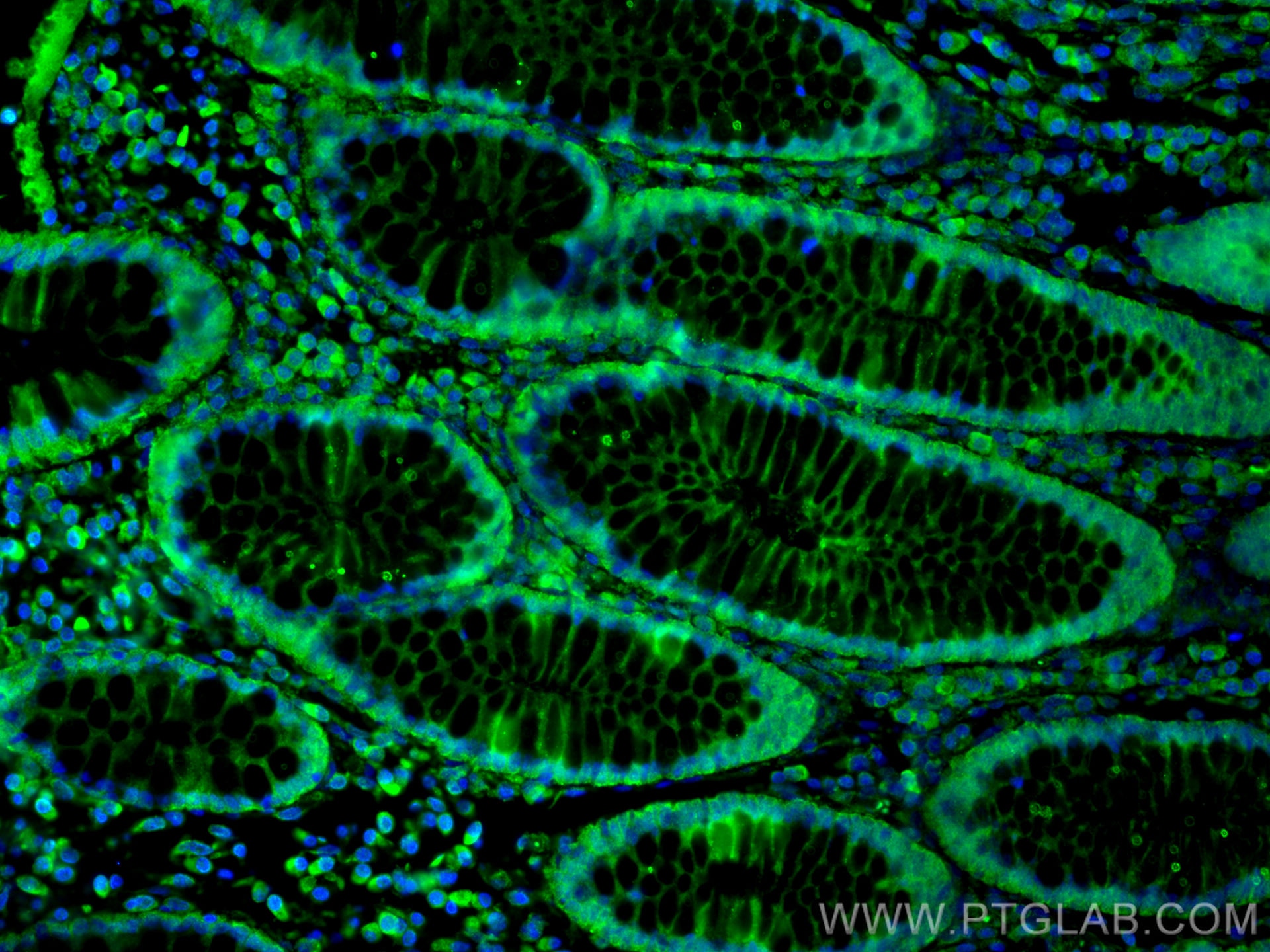Immunofluorescence (IF) / fluorescent staining of human colon cancer tissue using Amphiregulin Polyclonal antibody (16036-1-AP)