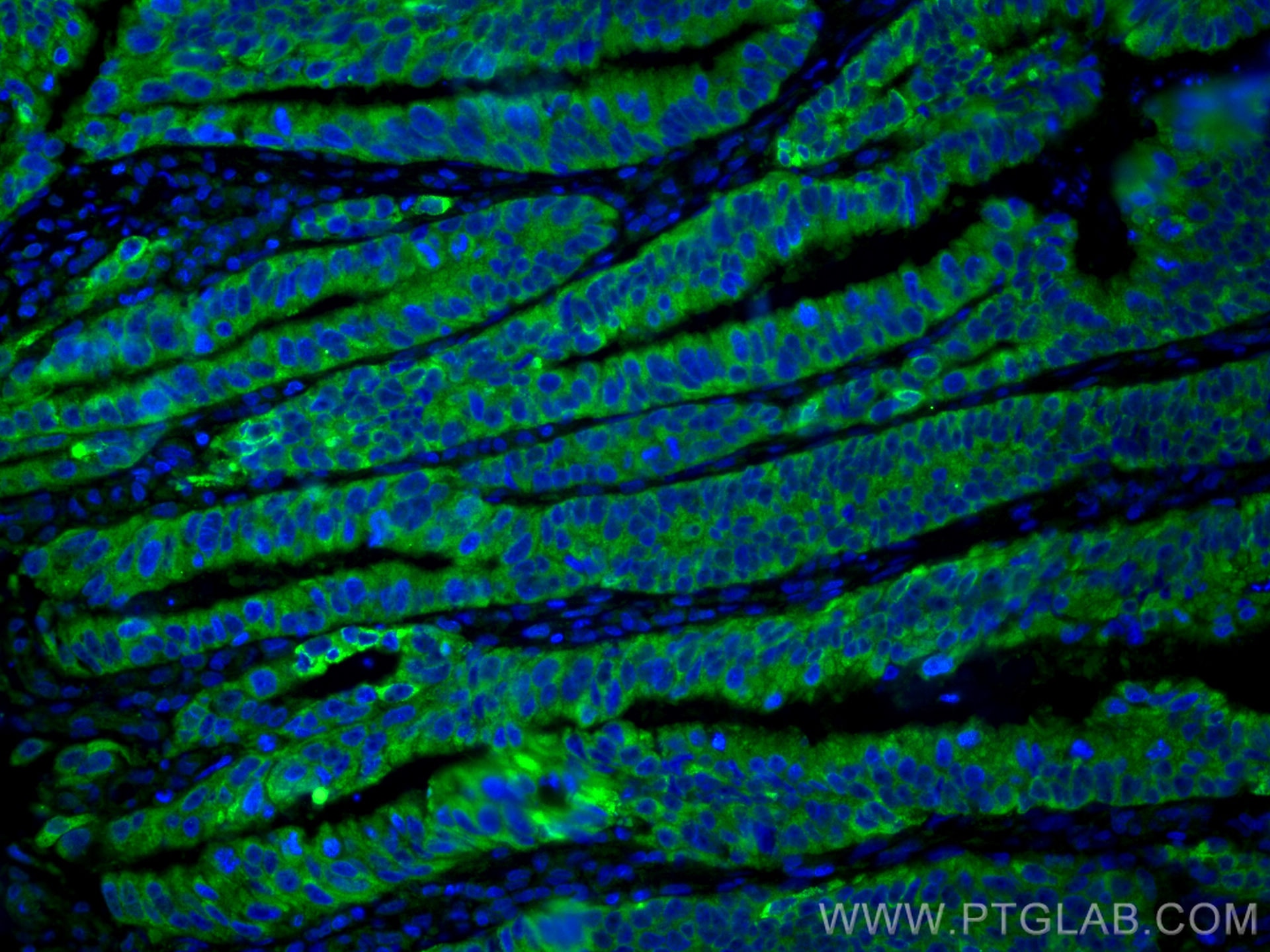 Immunofluorescence (IF) / fluorescent staining of human colon cancer tissue using Amphiregulin Polyclonal antibody (16036-1-AP)