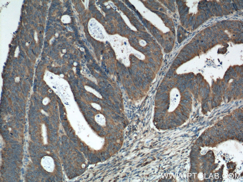 Immunohistochemistry (IHC) staining of human colon cancer tissue using Amphiregulin Polyclonal antibody (16036-1-AP)