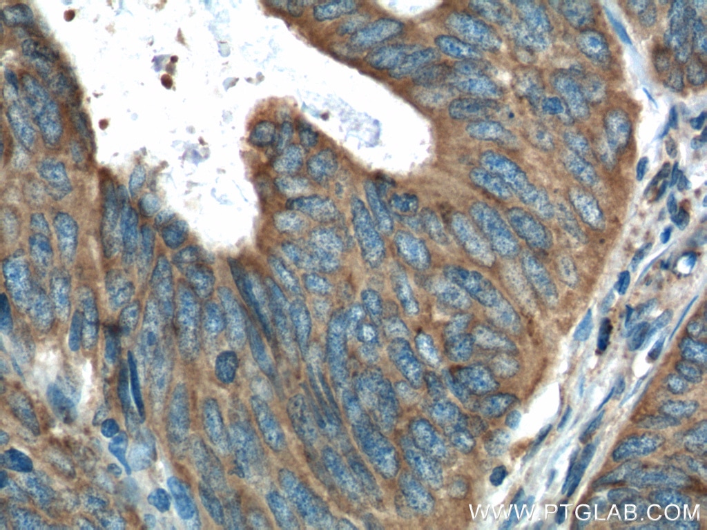 IHC staining of human colon cancer using 16036-1-AP