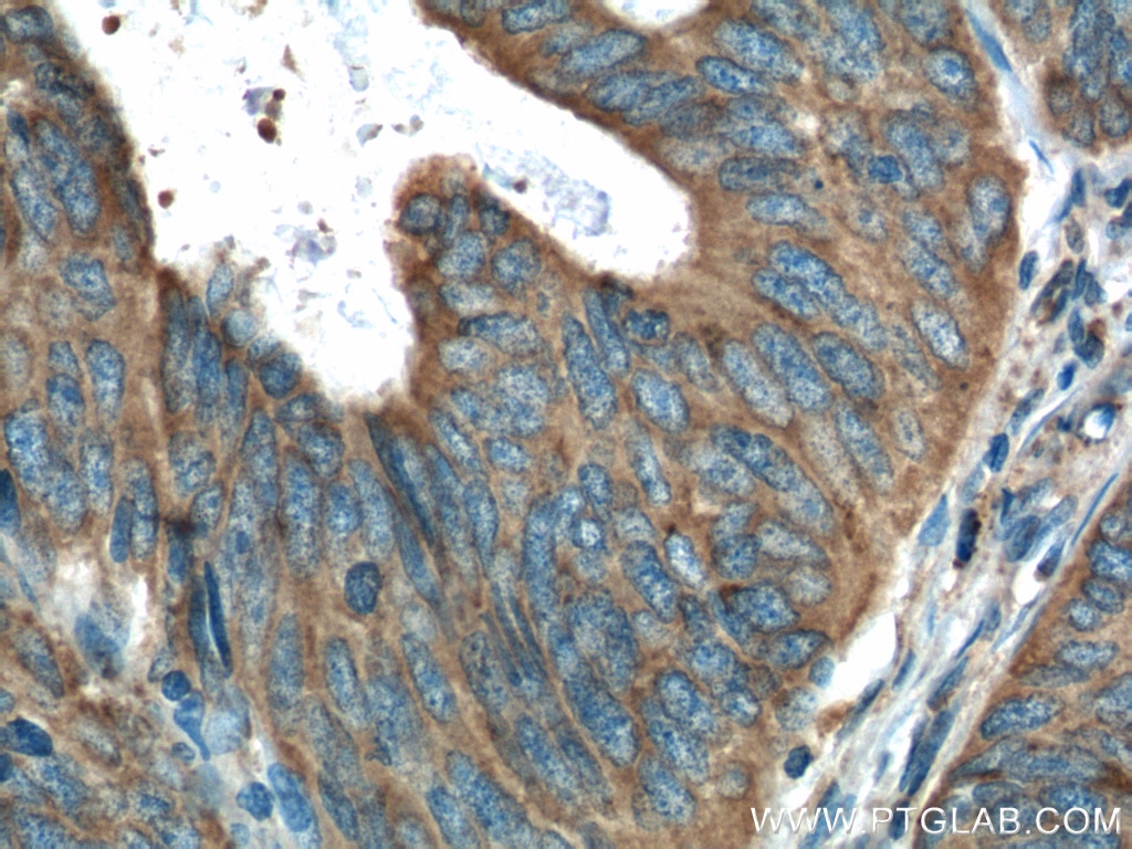 Immunohistochemistry (IHC) staining of human colon cancer tissue using Amphiregulin Polyclonal antibody (16036-1-AP)