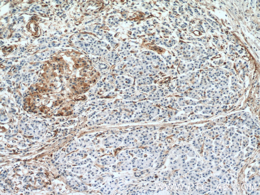 Immunohistochemistry (IHC) staining of human pancreas cancer tissue using Amphiregulin Monoclonal antibody (66433-1-Ig)