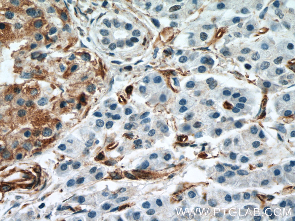 Immunohistochemistry (IHC) staining of human pancreas cancer tissue using Amphiregulin Monoclonal antibody (66433-1-Ig)
