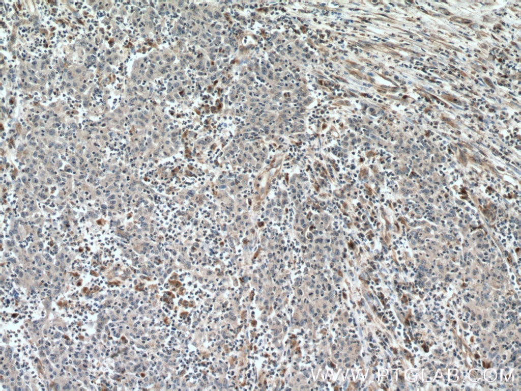 Immunohistochemistry (IHC) staining of human colon cancer tissue using Amphiregulin Monoclonal antibody (66433-1-Ig)