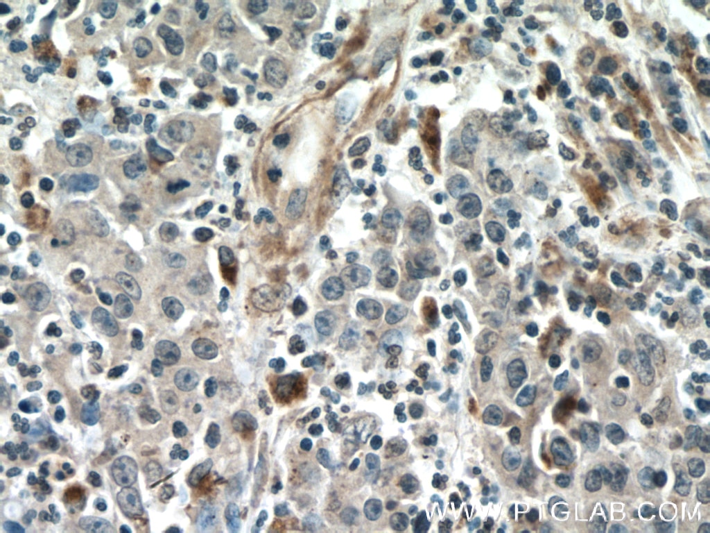 Immunohistochemistry (IHC) staining of human colon cancer tissue using Amphiregulin Monoclonal antibody (66433-1-Ig)