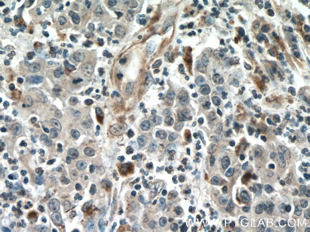 IHC staining of human colon cancer using 66433-1-Ig