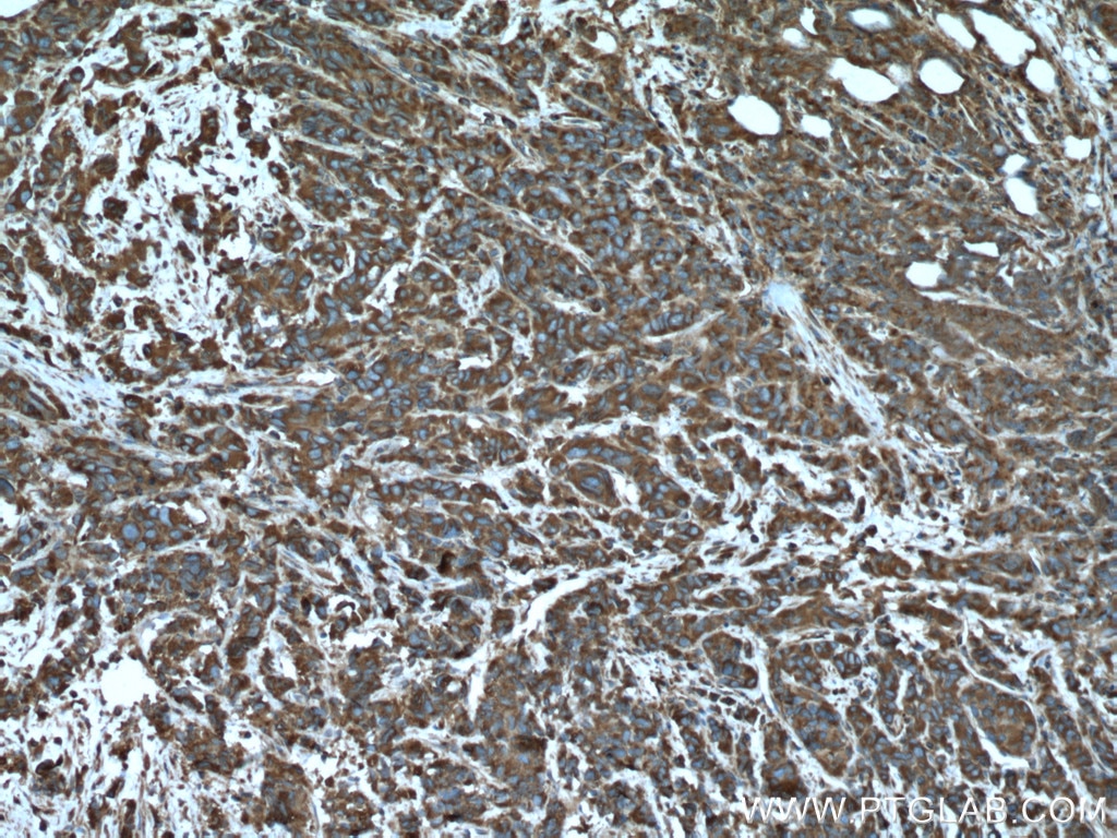 Immunohistochemistry (IHC) staining of human prostate cancer tissue using ARF1 Polyclonal antibody (10790-1-AP)
