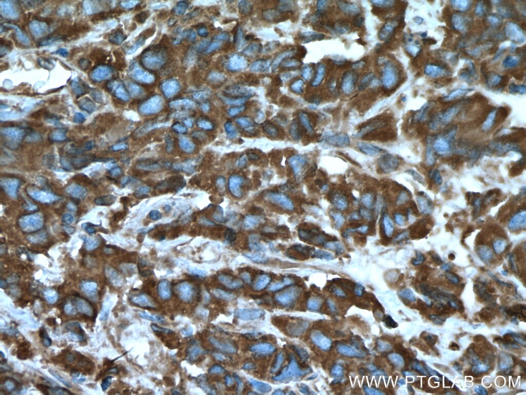 Immunohistochemistry (IHC) staining of human prostate cancer tissue using ARF1 Polyclonal antibody (10790-1-AP)