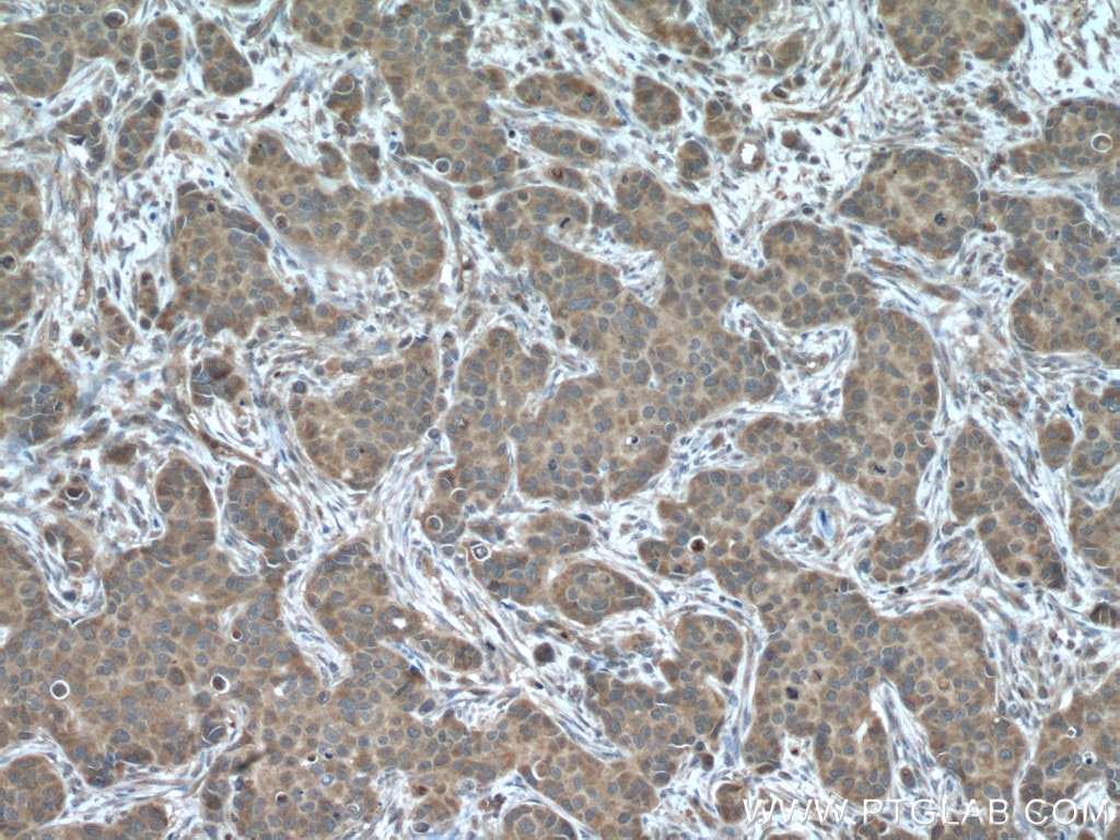 Immunohistochemistry (IHC) staining of human breast cancer tissue using ARF1 Polyclonal antibody (10790-1-AP)