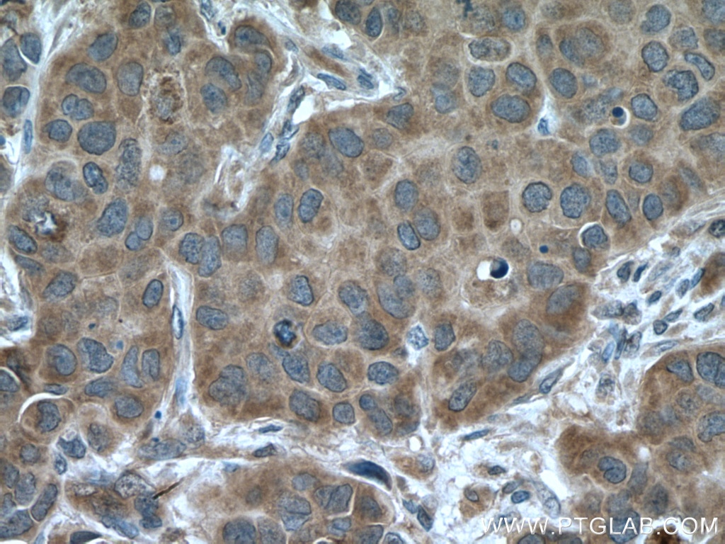 Immunohistochemistry (IHC) staining of human breast cancer tissue using ARF1 Polyclonal antibody (10790-1-AP)