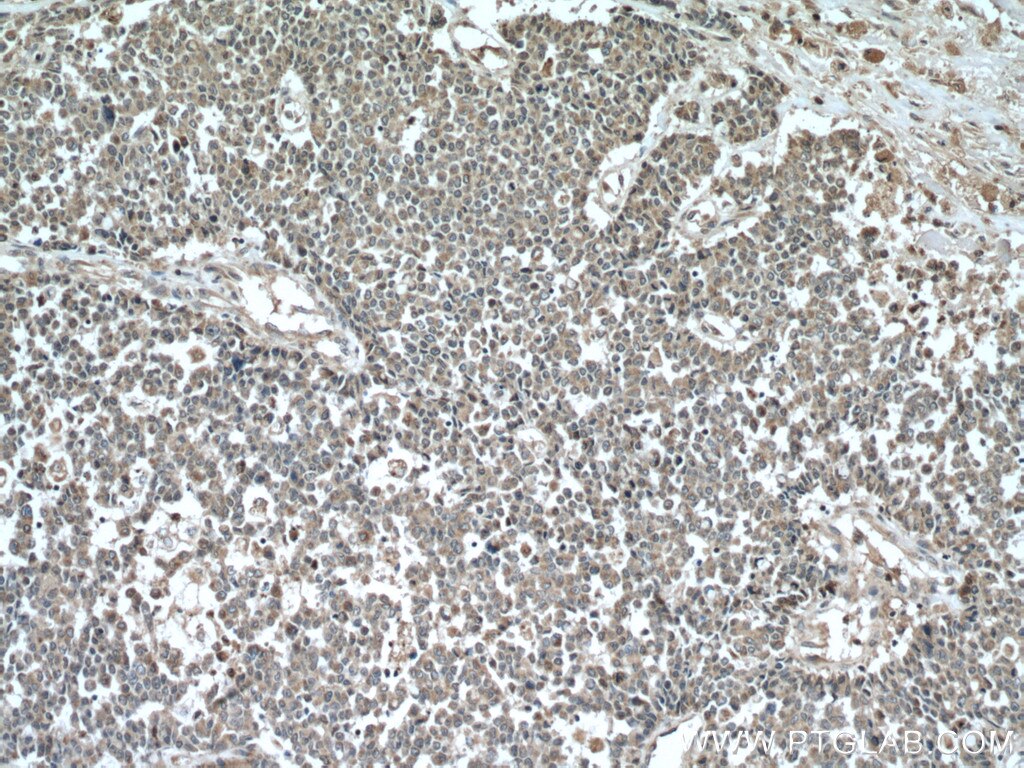 Immunohistochemistry (IHC) staining of human colon cancer tissue using ARF1 Polyclonal antibody (10790-1-AP)