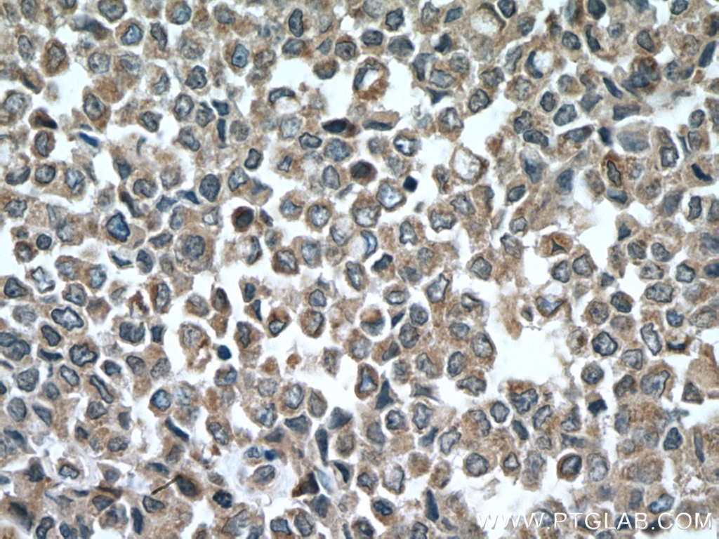 Immunohistochemistry (IHC) staining of human colon cancer tissue using ARF1 Polyclonal antibody (10790-1-AP)