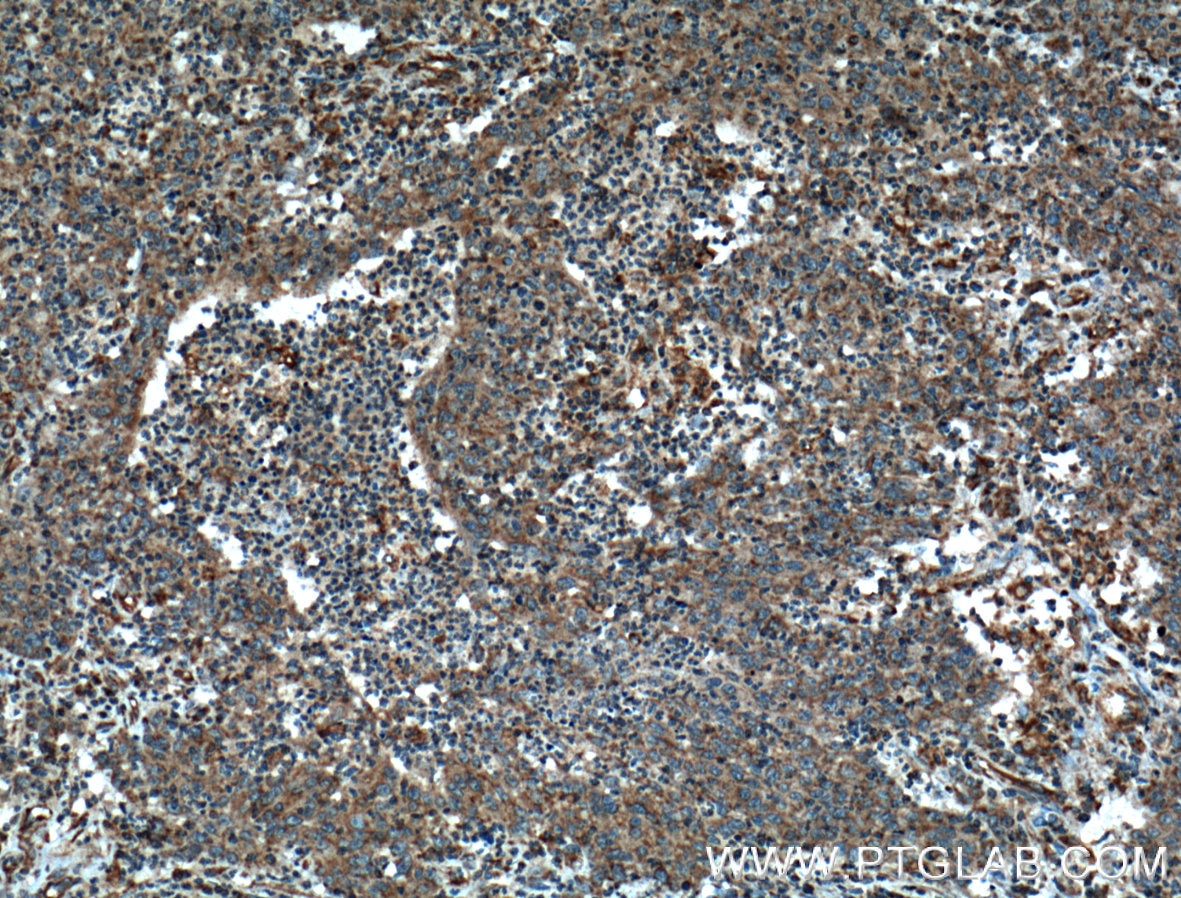 Immunohistochemistry (IHC) staining of human colon cancer tissue using ARF1 Polyclonal antibody (20226-1-AP)