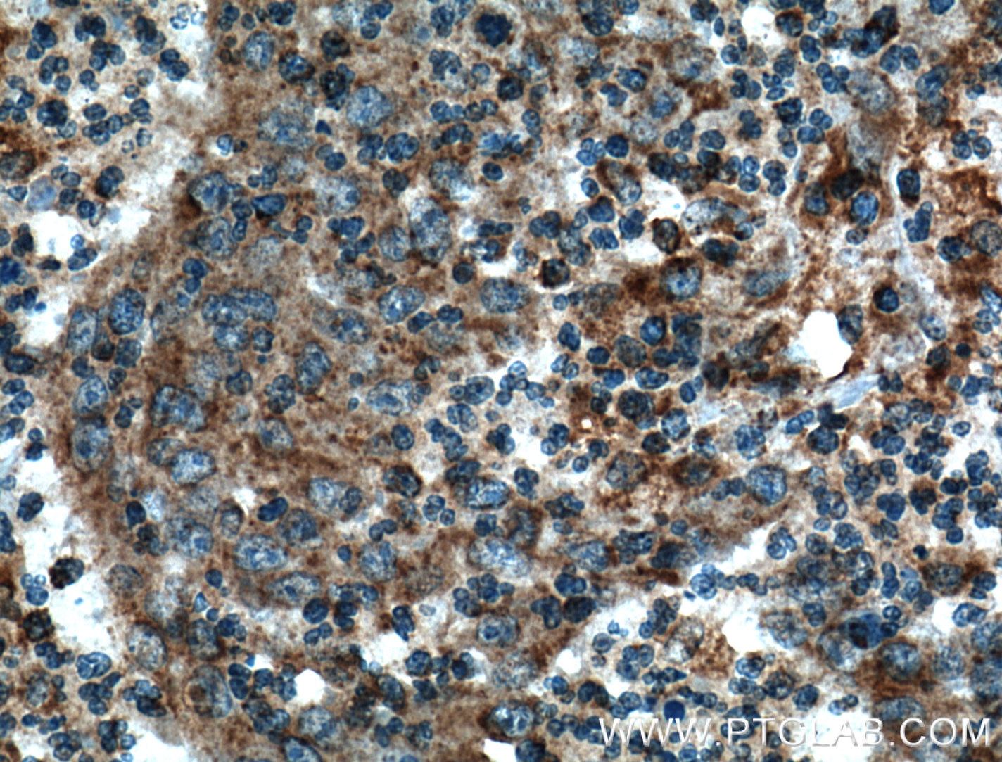 Immunohistochemistry (IHC) staining of human colon cancer tissue using ARF1 Polyclonal antibody (20226-1-AP)
