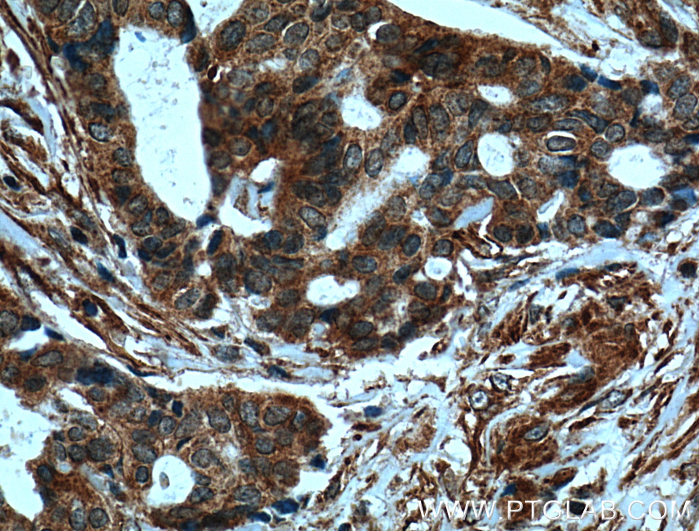 Immunohistochemistry (IHC) staining of human breast cancer tissue using ARF1 Polyclonal antibody (20226-1-AP)