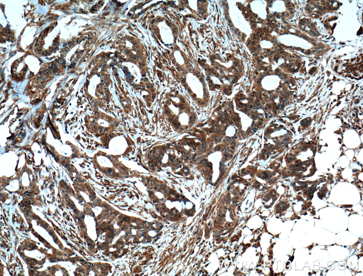 Immunohistochemistry (IHC) staining of human breast cancer tissue using ARF1 Polyclonal antibody (20226-1-AP)