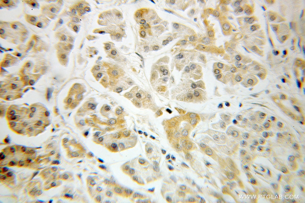 Immunohistochemistry (IHC) staining of human pancreas cancer tissue using ARF3 Polyclonal antibody (10800-1-AP)