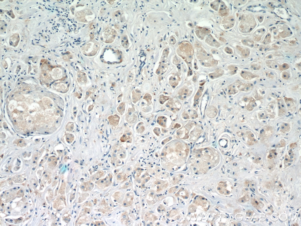Immunohistochemistry (IHC) staining of human breast cancer tissue using ARF3 Polyclonal antibody (22289-1-AP)