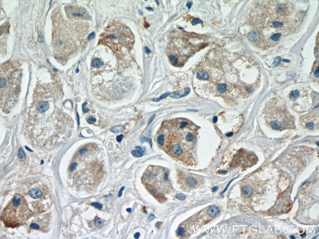 Immunohistochemistry (IHC) staining of human breast cancer tissue using ARF3 Polyclonal antibody (22289-1-AP)