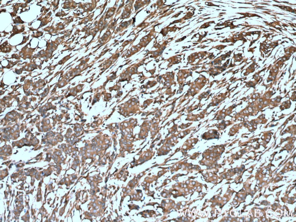 Immunohistochemistry (IHC) staining of human breast cancer tissue using ARF4 Polyclonal antibody (11673-1-AP)