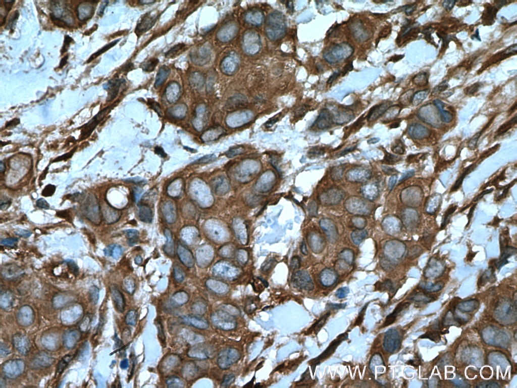 Immunohistochemistry (IHC) staining of human breast cancer tissue using ARF4 Polyclonal antibody (11673-1-AP)