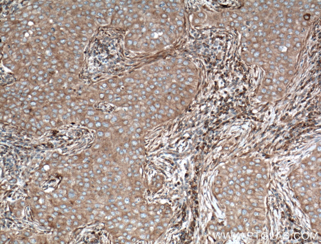 Immunohistochemistry (IHC) staining of human breast cancer tissue using ARF5 Polyclonal antibody (15281-1-AP)