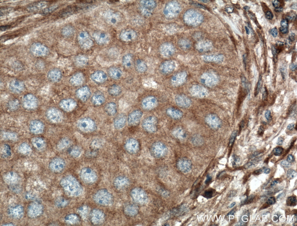 Immunohistochemistry (IHC) staining of human breast cancer tissue using ARF5 Polyclonal antibody (15281-1-AP)