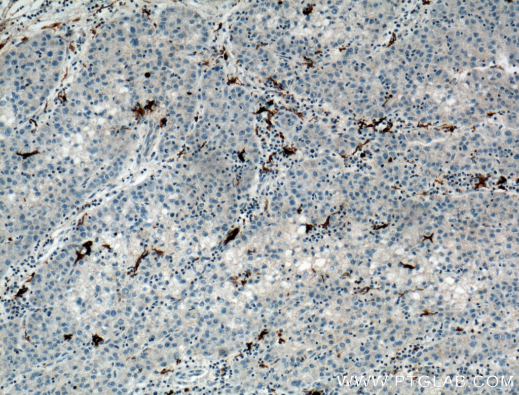 Immunohistochemistry (IHC) staining of human liver cancer tissue using ARF6-Specific Polyclonal antibody (20225-1-AP)