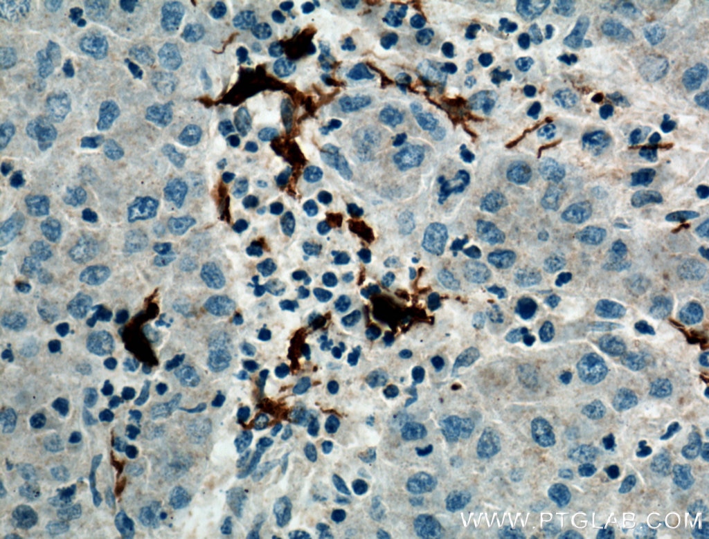 Immunohistochemistry (IHC) staining of human liver cancer tissue using ARF6-Specific Polyclonal antibody (20225-1-AP)