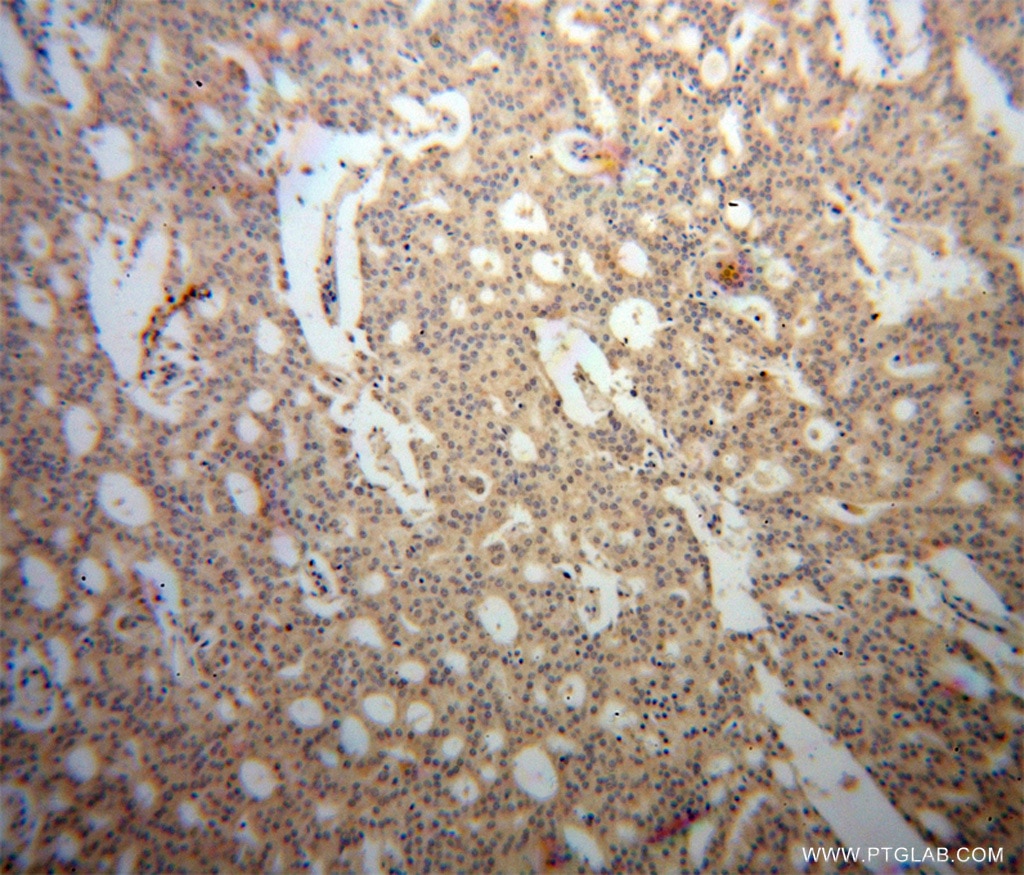 Immunohistochemistry (IHC) staining of human prostate cancer tissue using ARFGAP1 Polyclonal antibody (13571-1-AP)