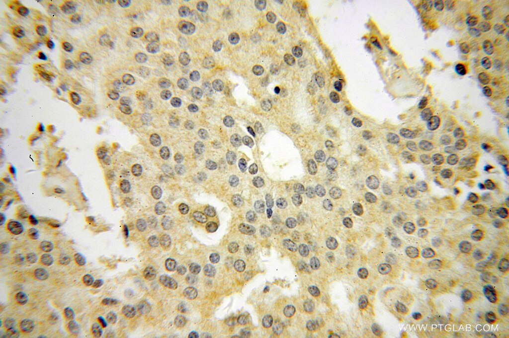 Immunohistochemistry (IHC) staining of human prostate cancer tissue using ARFGAP1 Polyclonal antibody (13571-1-AP)