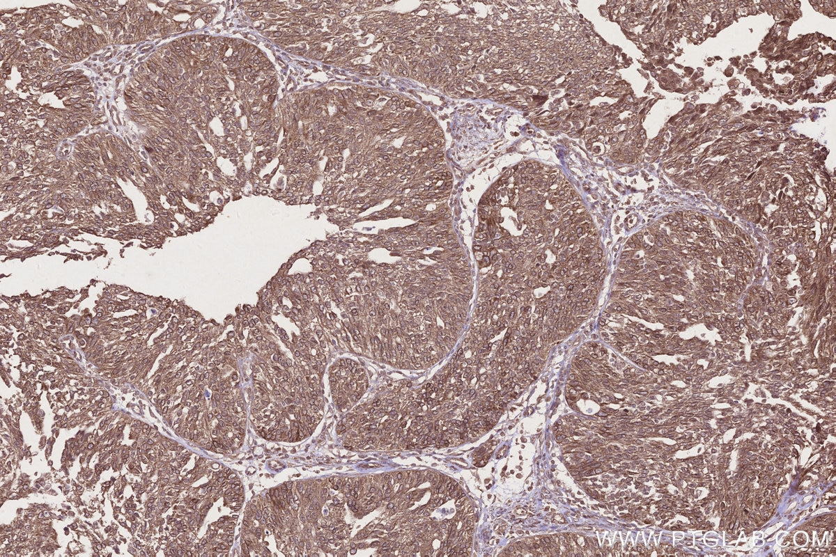 IHC staining of human ovary cancer using 16519-1-AP Immunohistochemistry (IHC) staining of human ovary cancer tissue using ARFGAP2 Polyclonal antibody (16519-1-AP)