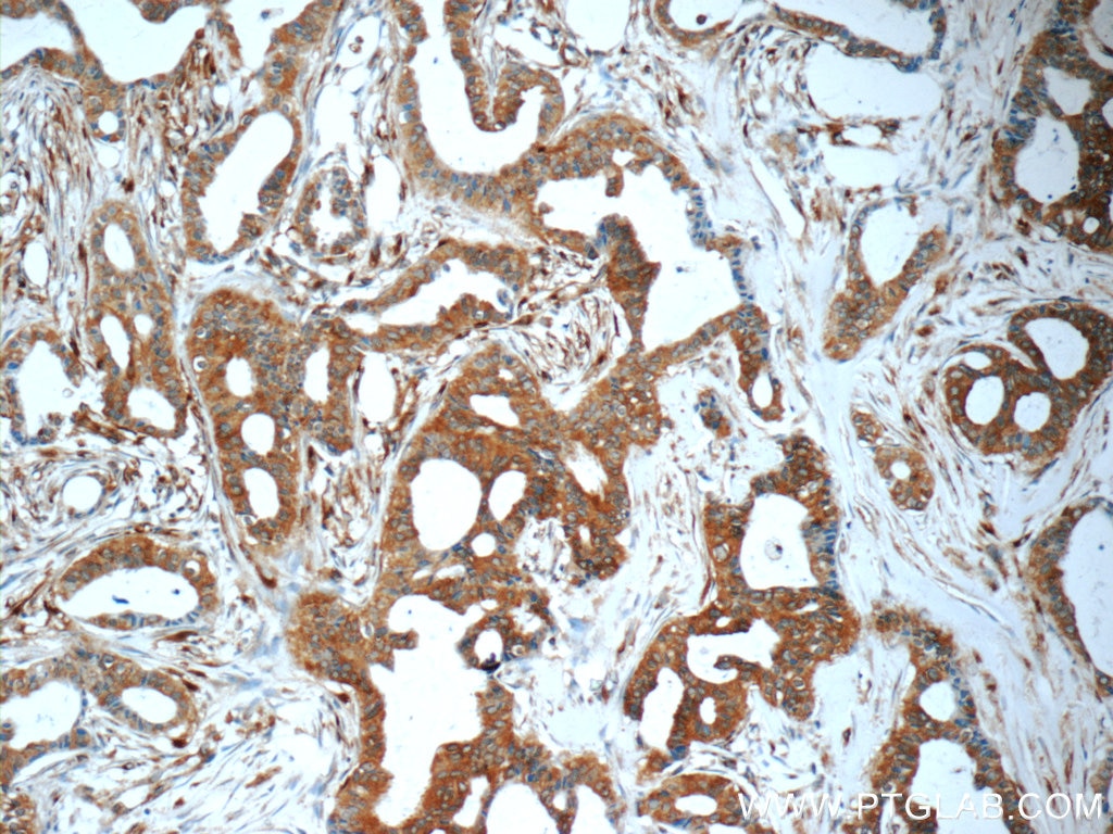 Immunohistochemistry (IHC) staining of human breast cancer tissue using ARFGAP3 Polyclonal antibody (15293-1-AP)