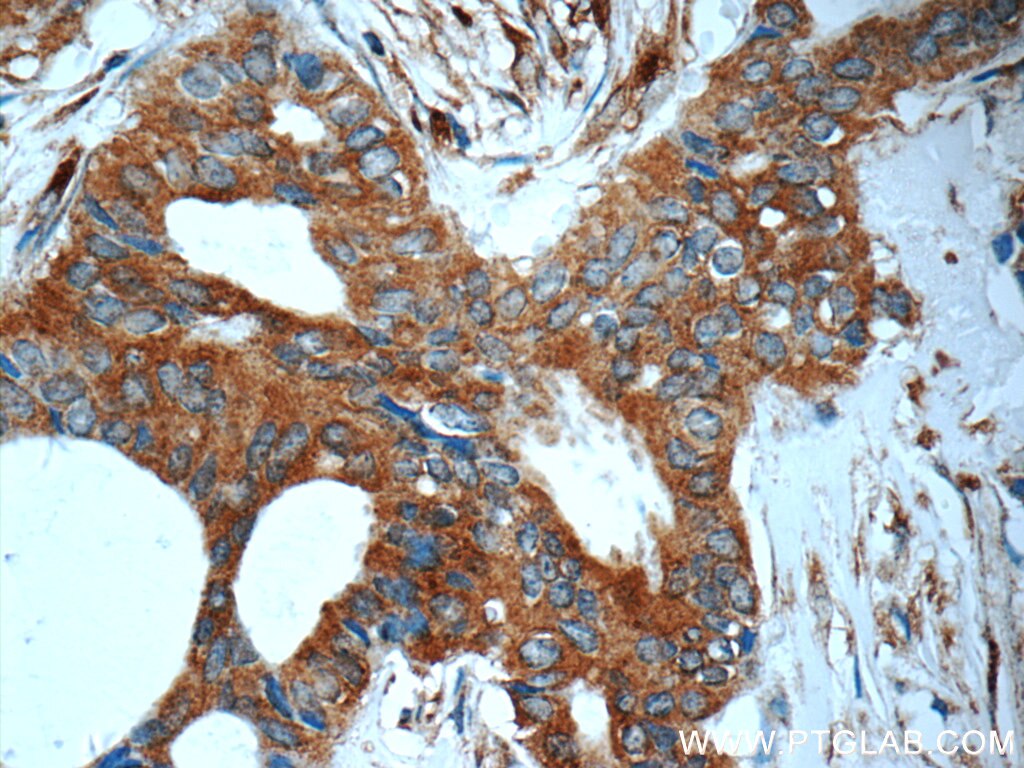 IHC staining of human breast cancer using 15293-1-AP