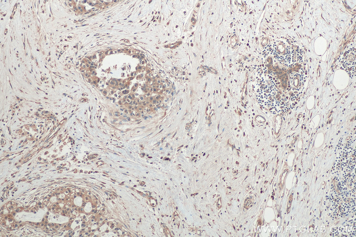 Immunohistochemistry (IHC) staining of human breast cancer tissue using ARFGAP3 Polyclonal antibody (15293-1-AP)