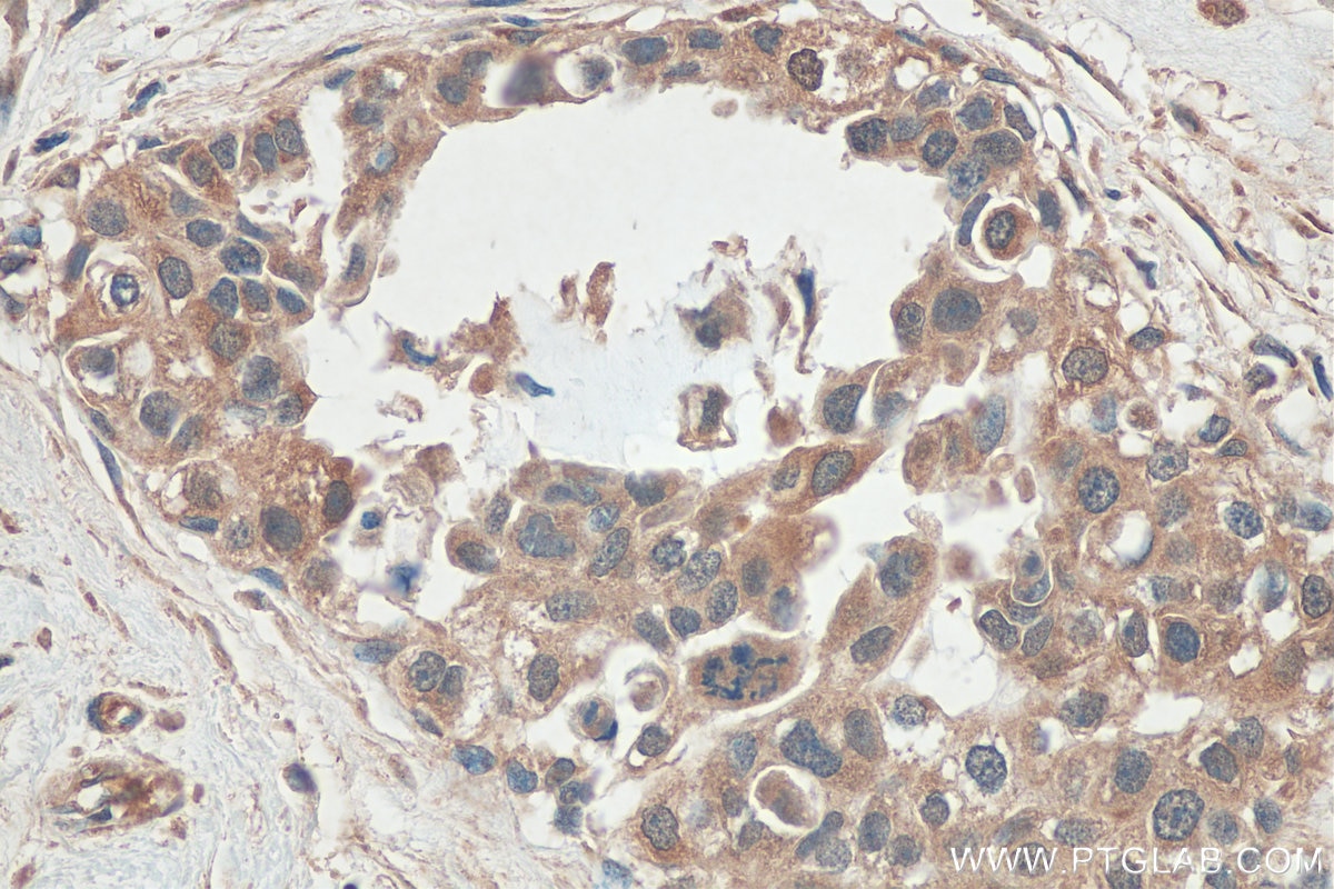 Immunohistochemistry (IHC) staining of human breast cancer tissue using ARFGAP3 Polyclonal antibody (15293-1-AP)