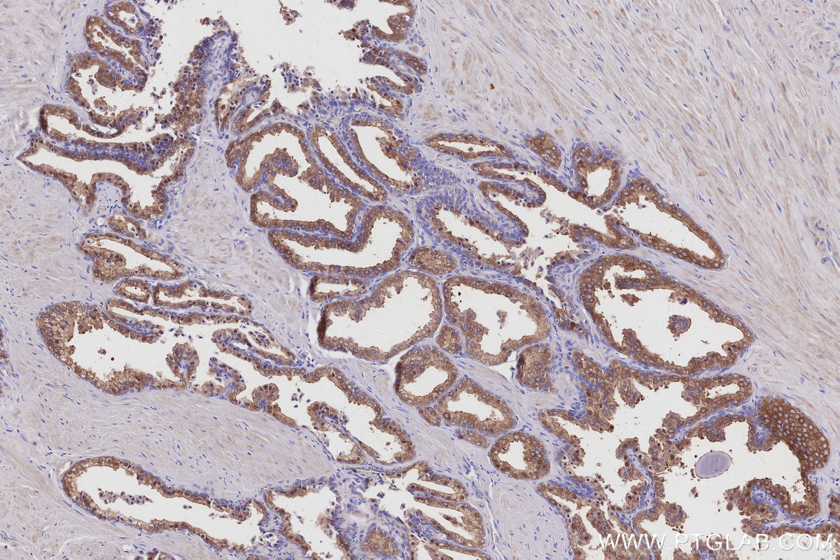 Immunohistochemistry (IHC) staining of human prostate hyperplasia tissue using ARFGAP3 Polyclonal antibody (15293-1-AP)
