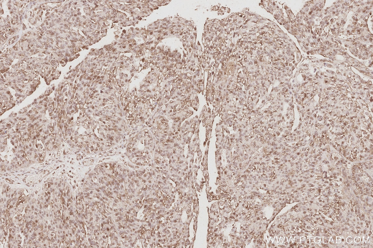 IHC staining of human ovary cancer using 31684-1-AP Immunohistochemistry (IHC) staining of human ovary cancer tissue using ARFGEF1 Polyclonal antibody (31684-1-AP)