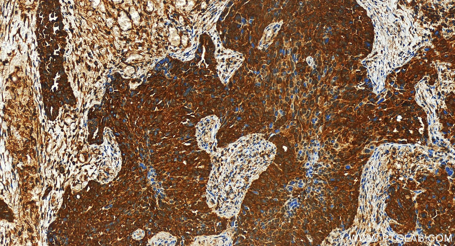 Immunohistochemistry (IHC) staining of human ovary cancer tissue using ARFGEF1 Polyclonal antibody (31684-1-AP)