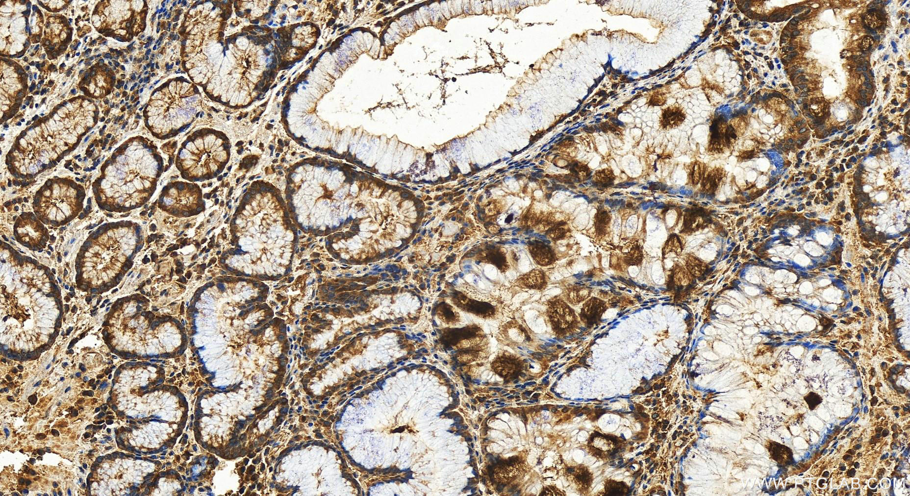 Immunohistochemistry (IHC) staining of human stomach cancer tissue using ARFGEF2 Polyclonal antibody (31277-1-AP)