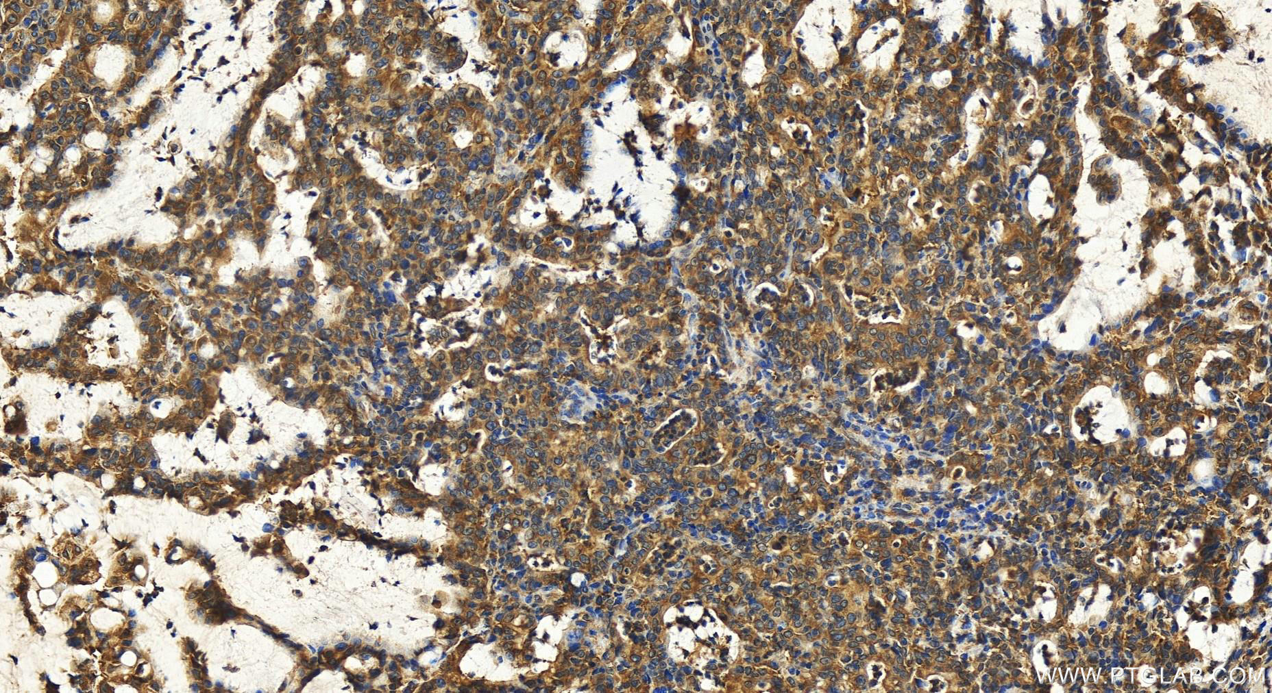 Immunohistochemistry (IHC) staining of human stomach cancer tissue using ARFGEF2 Polyclonal antibody (31277-1-AP)