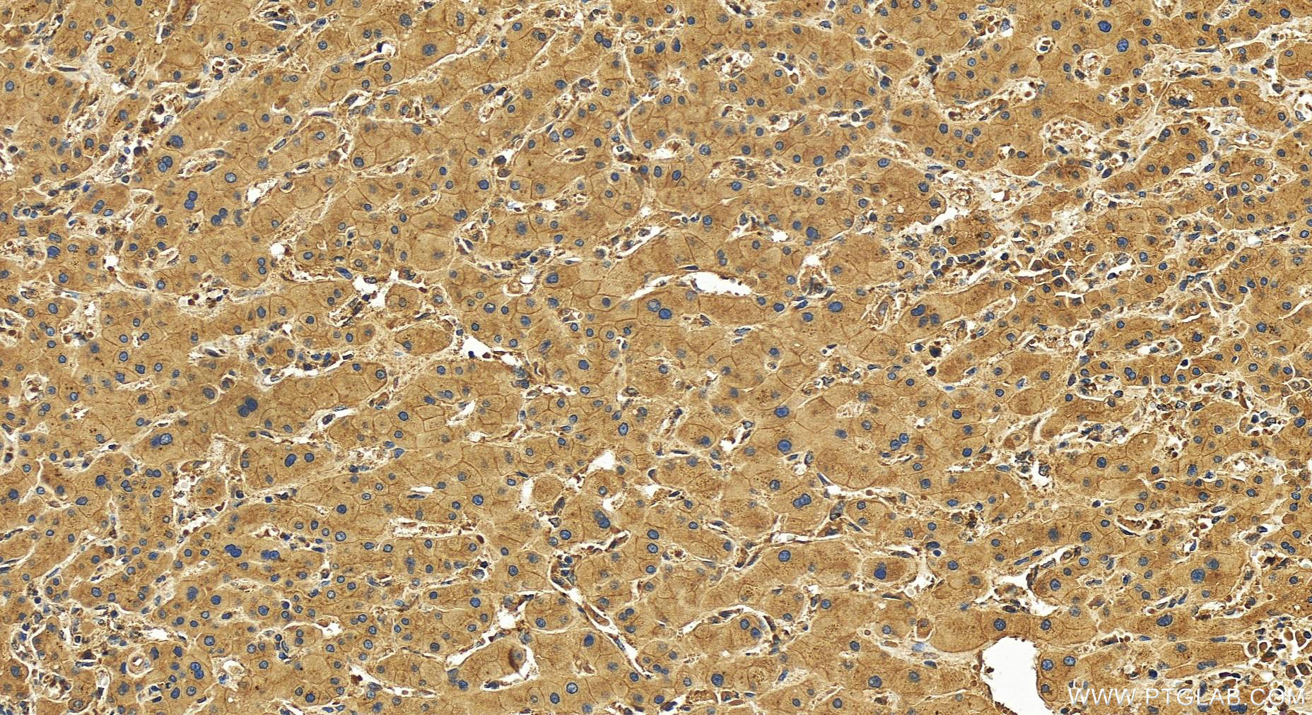 Immunohistochemistry (IHC) staining of human intrahepatic cholangiocarcinoma tissue using ARFGEF2 Polyclonal antibody (31277-1-AP)